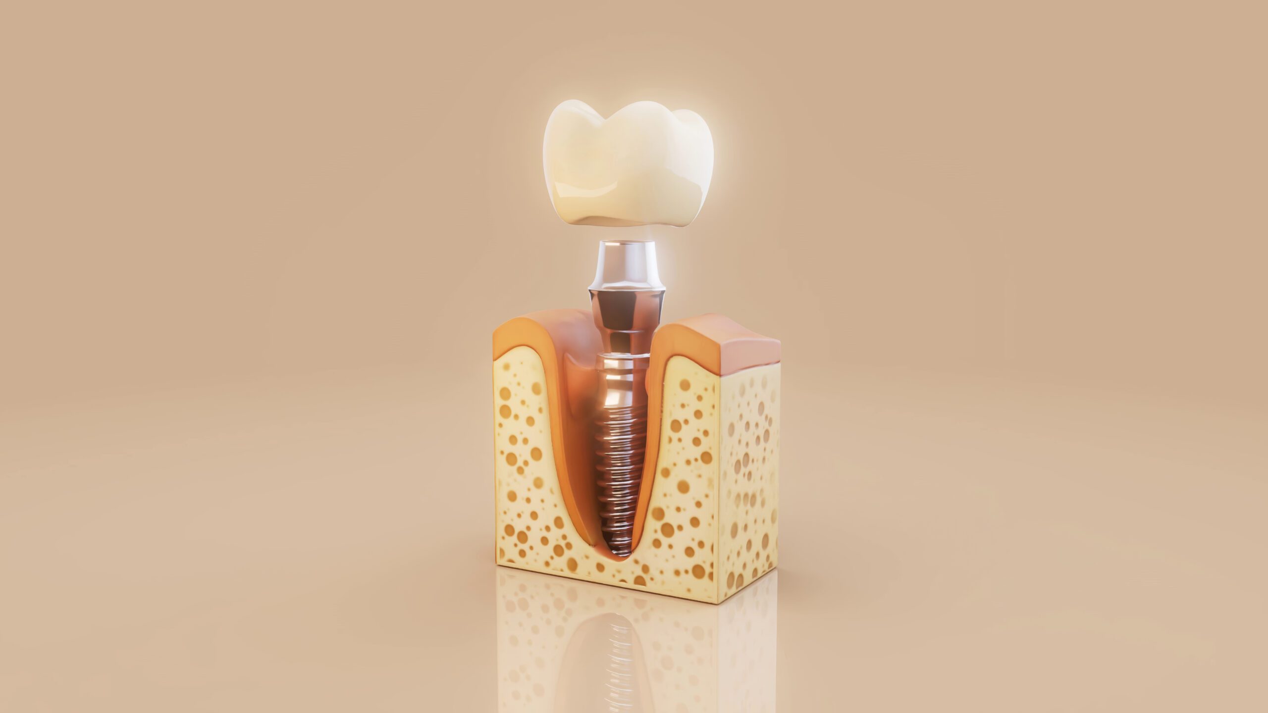 conceptual 3d illustration dental implant inside jawbone scaled